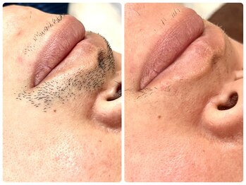 シシエル(CHICIEL)/ヒゲ脱毛 口周り青ヒゲ経過30代