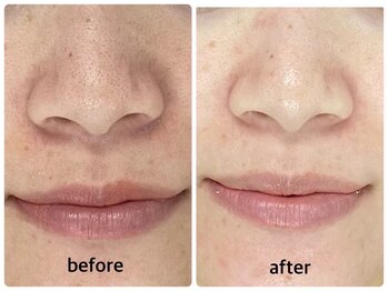 アルゴ 熊本光の森店(ALGO)/【水光肌】トーンアップ！