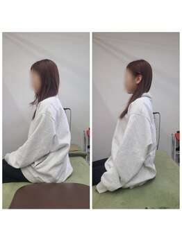 整骨院がじゅまる堂/[姿勢矯正] before/after