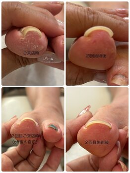 巻き爪矯正
