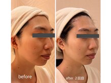 クリニカルエステ/イーズ パークプレイス大分店/20代後半#小顔#毛穴