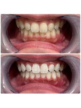 エクシアホワイトニング 日本橋店/ホワイトニング人形町