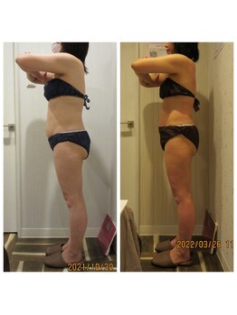 痩身脱毛専門店 グレイスボディ MEGAドンキホーテ三郷店(Gracebody)/◆痩身　症例写真