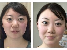 エクラ(Eclat)/小顔/肌質改善/たるみケア専門