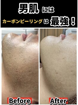 キムラケ(KIMURAKE)/脱毛とカーボンピーリングで!