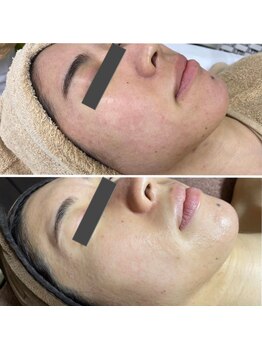 ヴィヴィ(ViVi)/【効果実感！】話題のHAABリプロ