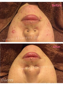 エステティックサロンティエリー/オーガニックプレミアムパウダー