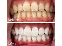 ホワイト 富山店(WHITE)の雰囲気（ホワイトニングビフォーアフター【6か月通い放題】）