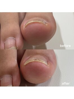 リリ(lili)/巻き爪矯正1回目(右親指)