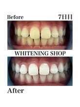 ホワイトニングショップ 西尾店/Before&After　7日目のお客様