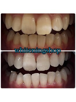 ホワイトニングショップ 三田店/before after