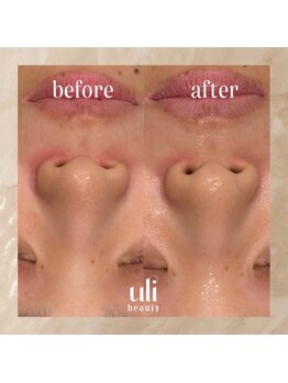 ウリ(uli beauty)/比較写真