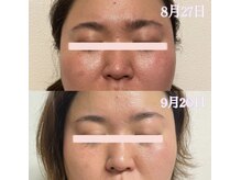 ピオニービューティー(Peony Beauty)/リアボーテ化粧品ホームケアのみ