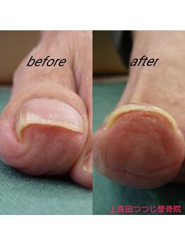 上高田つつじ整体院/巻き爪　ネイルケア　例