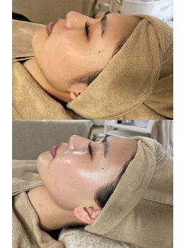 ミーミドットアイ(Mi-mi.i)/艶肌フェイシャルワックス脱毛