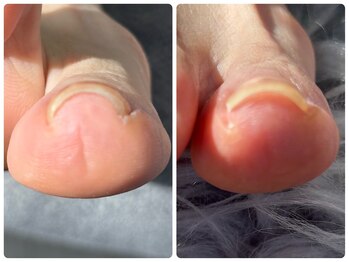 爪のいろは/巻き爪?爪切りだけで不快感軽減