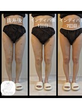 アリビオ(ALIVIO)/美容施術前後ケア