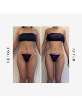 ラグレ(LUXRE)/脂肪冷却モニター（30代）