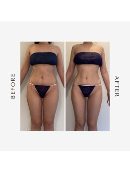 ラグレ(LUXRE)/脂肪冷却モニター（30代）