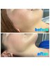 ≪お顔のダブル脱毛≫フェイシャルWAX＋光脱毛＋高濃度炭酸クレイパック