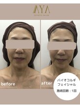 アヤエステティックサロン 綱島店(AYA)/最強リフトアップ！