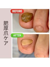 ドクターネイル爪革命 群馬両毛店/肥厚爪・変形爪ケア
