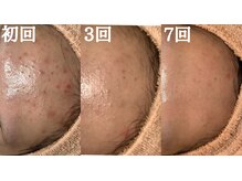 シャルナ(charna)の雰囲気（ニキビ、跡ケア　改善しない症状はありません）