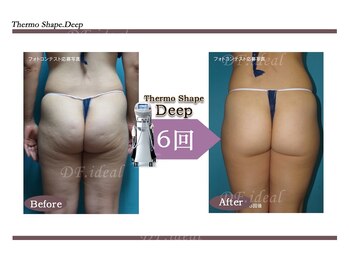 Nビューティー/最新エンダモロジーBODY