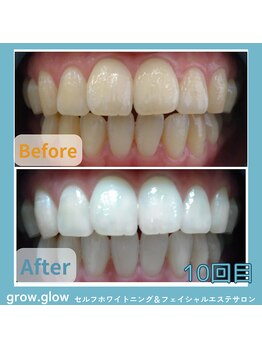 グロウ グロウ(grow.glow)/調布ホワイトニング