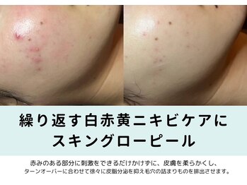 コキュウ お顔ラボ(KOKYU お顔LABO)/コメドや赤み、肌荒れに