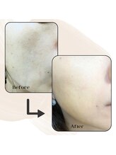 ヴィセル(VISEL)/ふっくら美肌