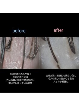マナワ(manawa)/ヘッドスパ施術 before→after