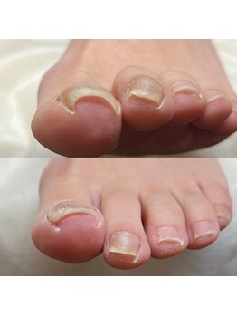 アップ 市ヶ尾整体院(UP)/巻き爪補正