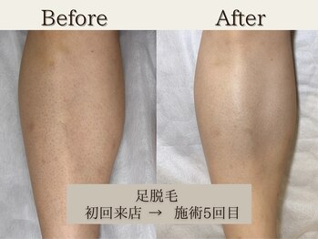 インベスト(INVEST)/足脱毛