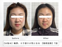 レッド(RED)/エラ張り、左右差解消◎