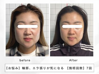 レッド(RED)/エラ張り、左右差解消◎