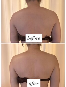 レア(Lea)/背中の浮腫み・肩の盛り上がり