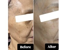 エステルーム アンジュ(Esthe Room Ange)/シミケア/ADSプログラム