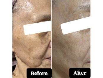 エステルーム アンジュ(Esthe Room Ange)/シミケア/ADSプログラム