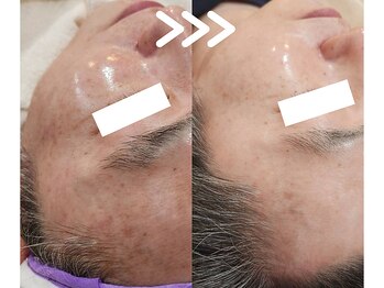 ソイ(Soi)/男性でこの美肌変化！