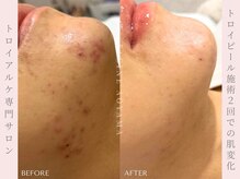 ファシネアオヤマ(FACINE AOYAMA)/トロイピール二回での肌変化