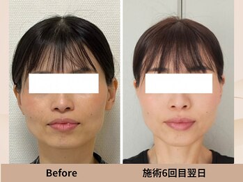 クローバー(clover)の写真/憧れの透明感肌へ☆血流を巡らせて、ワントーン明るい印象に！