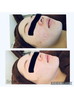 スノースキン(Snow skin)/【肌が弱い方、薄い方】