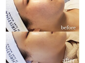 カサブランカ(CASABLANCA)/ILLUSTRIOUS症例