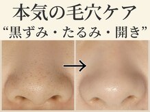 オーシャンブルー 福岡店(OCEAN BLUE フェイシャル&ボディ)の雰囲気（毛穴洗浄で黒ずみ汚れもスッキリ！毛穴のお悩みもお任せください）