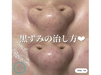 ミラーヴ(MERAVE)/黒ずみは改善します！