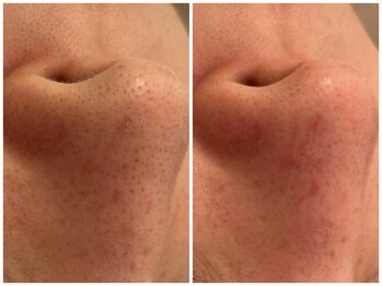 メゾンリュバン 梅田店(Maison Ruban)/毛穴洗浄・美白フォト|毛穴ケア