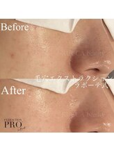 オーバイルッカ(O by RUCCA)/毛穴エクストラクションプロ