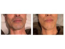 アンド エヌ(&n)/◆髭脱毛◆