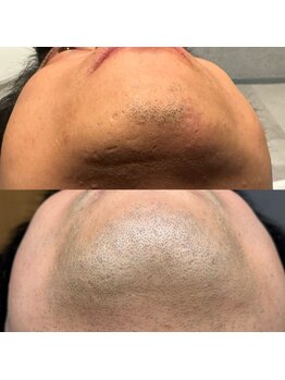 エピノン 山口岩国店(Epinon)/4回 顔脱毛